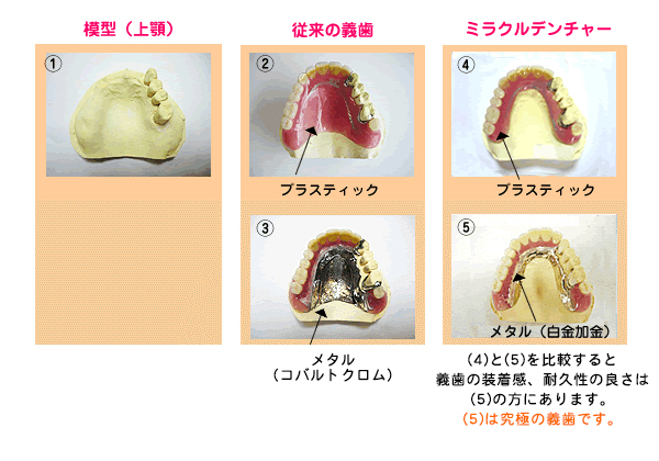 ミラクルデンチャーと通常の入れ歯との比較画像